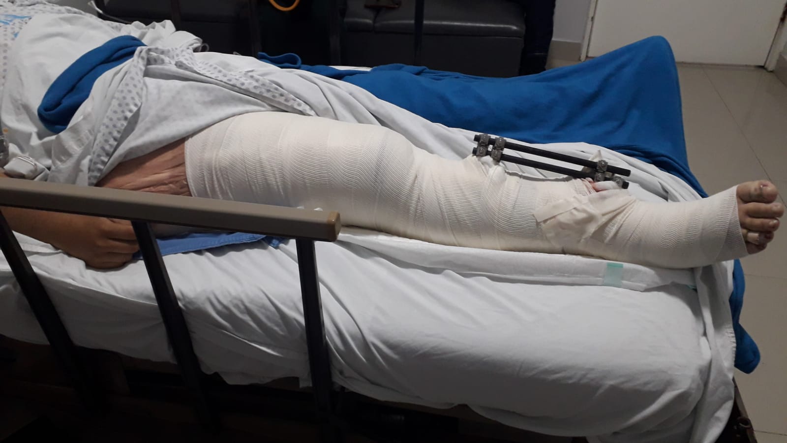 Solicitan familiares de joven mochitense apoyo económico para la operación de su pierna