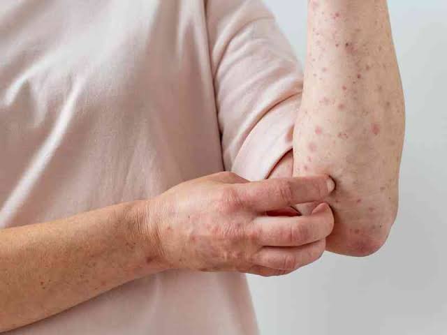 ¡Se cancelan las caricias! Contacto físico íntimo aumentan probabilidades de contraer viruela del mono