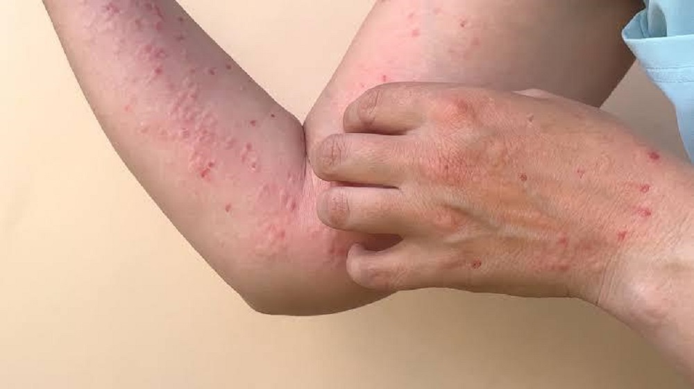 Hay seis sospechosos de viruela del mono en Sinaloa: SSA
