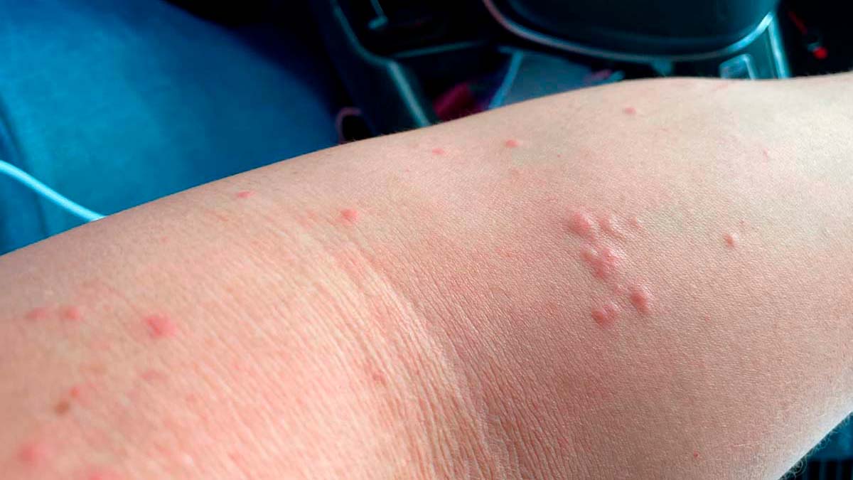 En Sinaloa hay otro caso positivo a viruela del mono; suman 14 contagiados