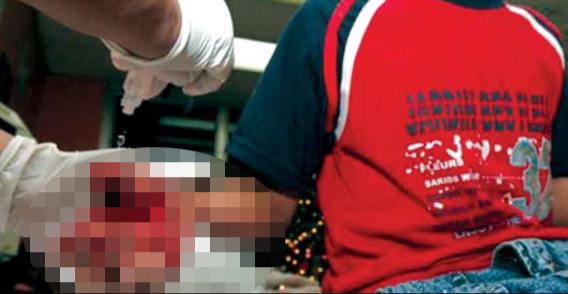 ¡No a la pirotecnia! Registra Cruz Roja 5 reportes de menores quemados por “cuetes”