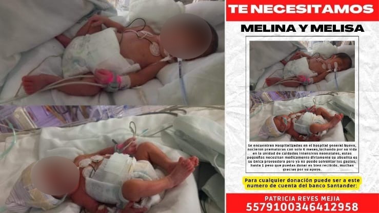Melina y Melisa nacieron de 6 meses en Mazatlán, ahora ocupan ayuda de la ciudadanía para salir adelante