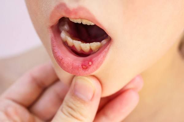 Detectan dos casos de virus Coxsackie en guardería del ISSSTE en Guasave, Sinaloa
