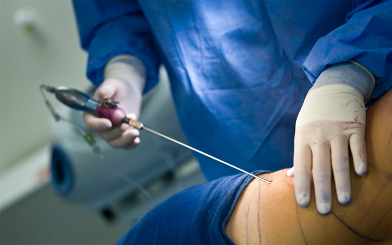 Coordina EU y SSA acciones por brote de meningitis en Texas, tras cirugías; Tamaulipas estudia 400 expedientes