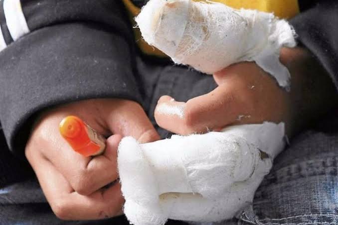 Hospitales, listos por si niños pierden extremidades por uso de pirotecnia: Cuitláhuac González