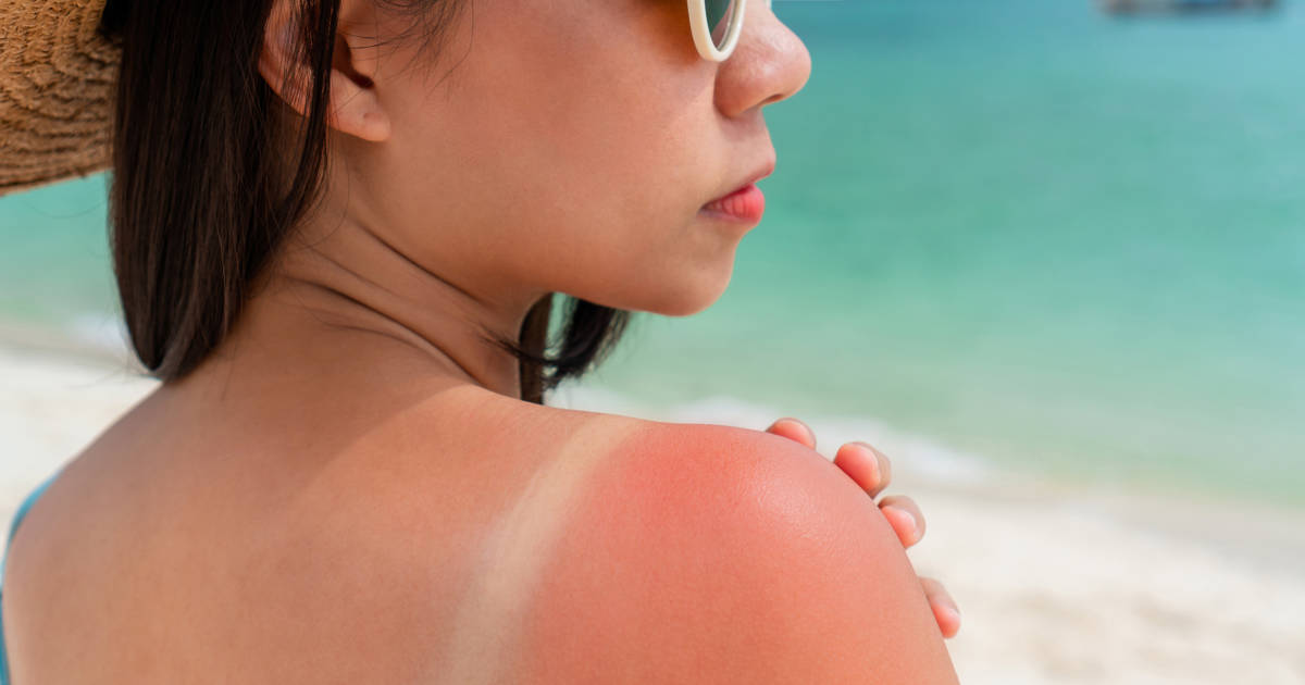 ¡Auch! Con estos remedios caseros alivia las quemaduras por el sol estas vacaciones