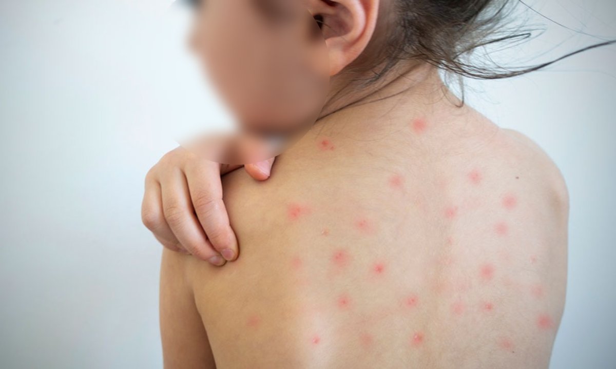 No hay alerta sanitaria por brote de sarampión en Sinaloa, el llamado a vacunarse es solo preventivo