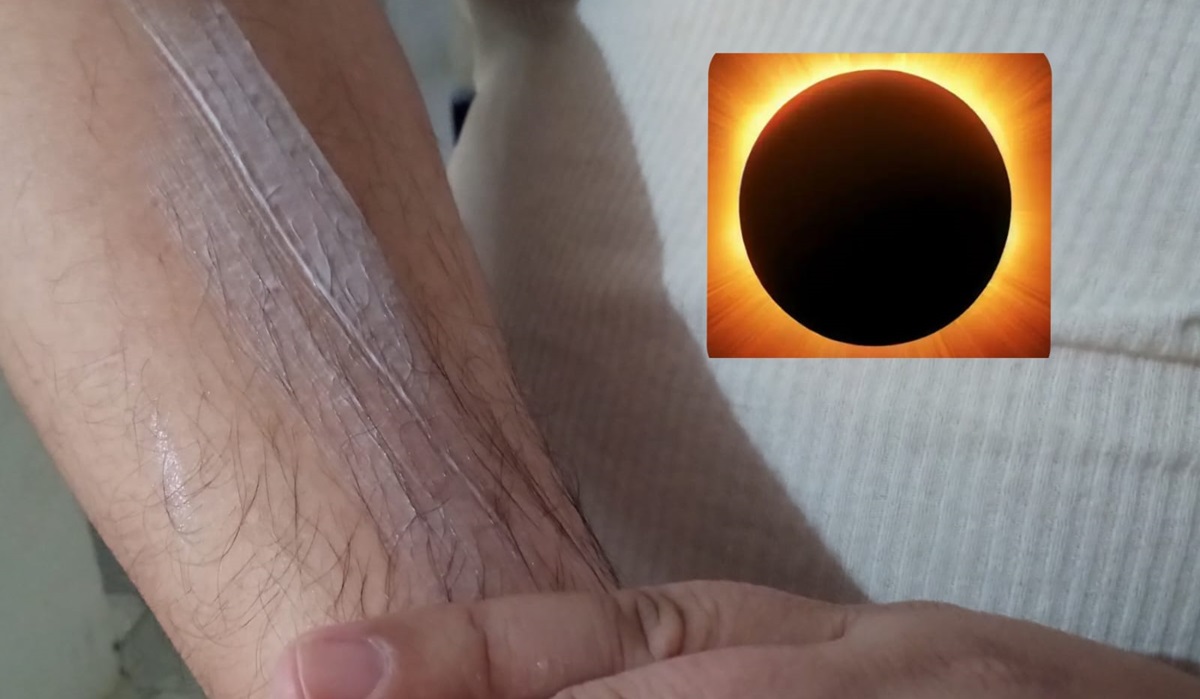 ¿Debo cuidar mi piel? Mitos que la gente aún cree cuando hay un eclipse solar