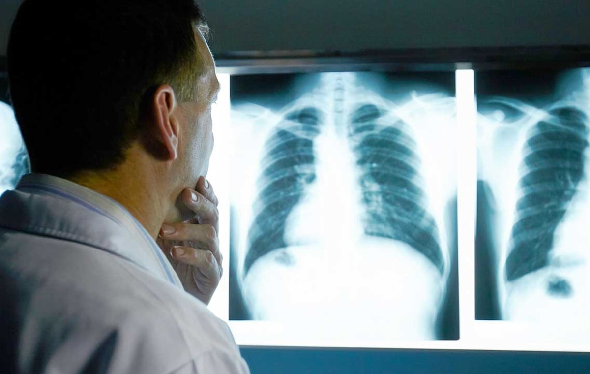 Día Nacional contra el Cáncer de Pulmón: ‘Silenciosamente’ mortal ¿con qué estudios se puede diagnosticar?