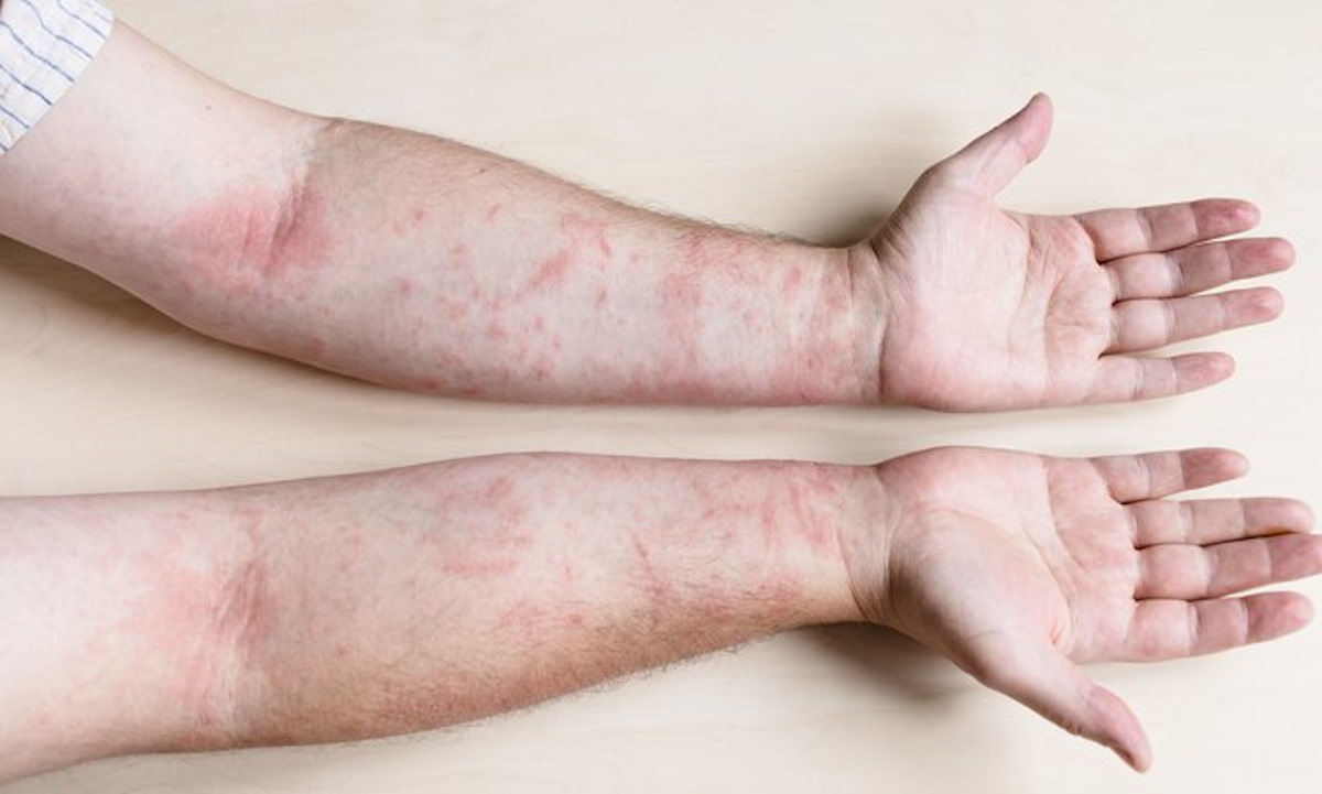 ¡Alerta! Dermatitis por calor ante altas temperaturas en México ¿Cómo prevenirla?