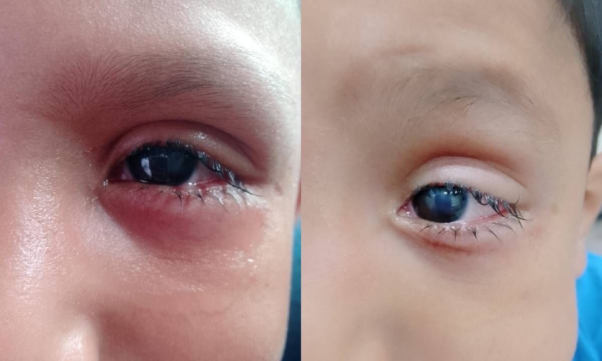 Por falta de oftalmólogo Edgar Iván de 6 años pierde su ojo, en Los Mochis