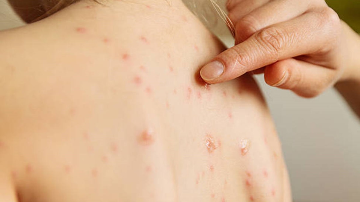 A la fecha suman 61 casos de mpox antes viruela del mono en México en lo que va del 2024