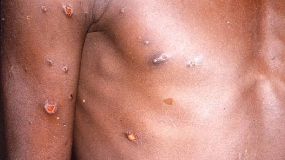 Mpox llega a Sonora: dos casos importados detectados