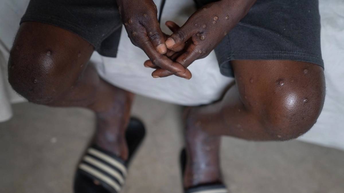 Emergencia: caso de mpox en Suecia genera alerta mundial
