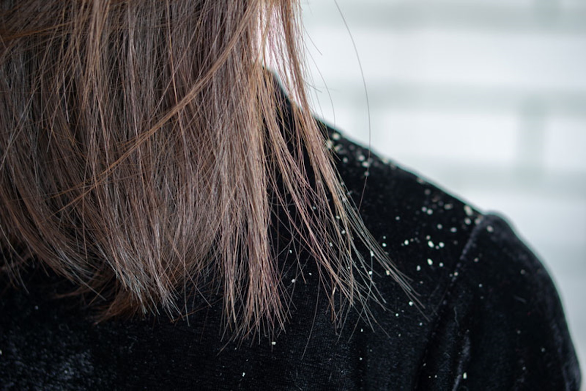 ¿Caspa en invierno? Cómo prevenirla y tratarla de manera natural