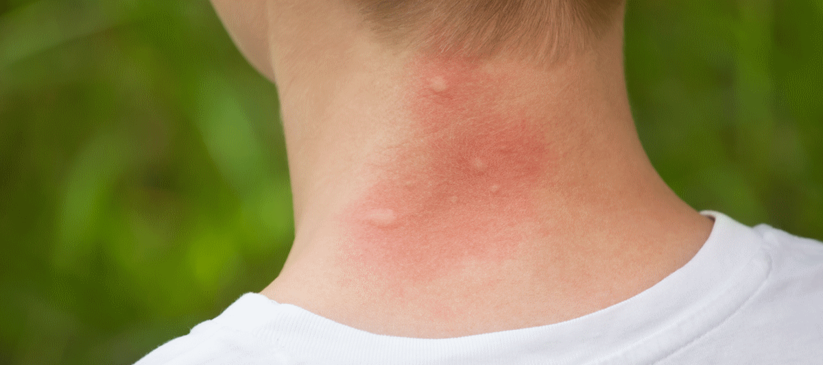 Consejos efectivos para aliviar la comezón por las picaduras de mosquitos