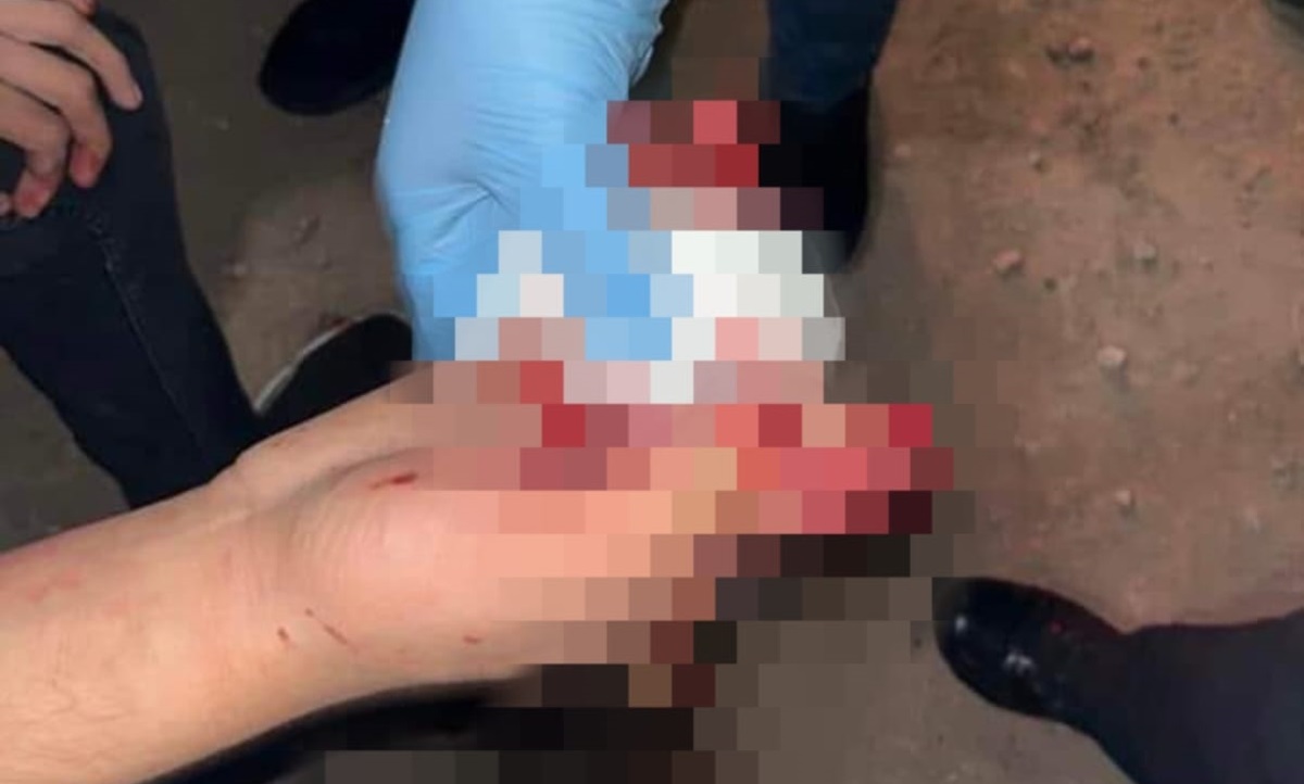Por usar pirotecnia, menor de 11 años, en Guasave, sufrió fuerte herida en una de sus manos