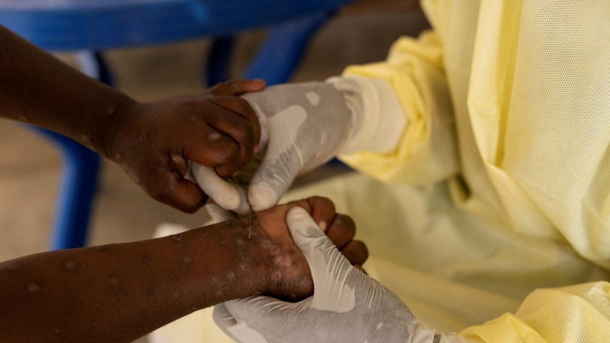 Enfermedad desconocida en Congo deja decenas de muertos ¿Qué se sabe hasta ahora?
