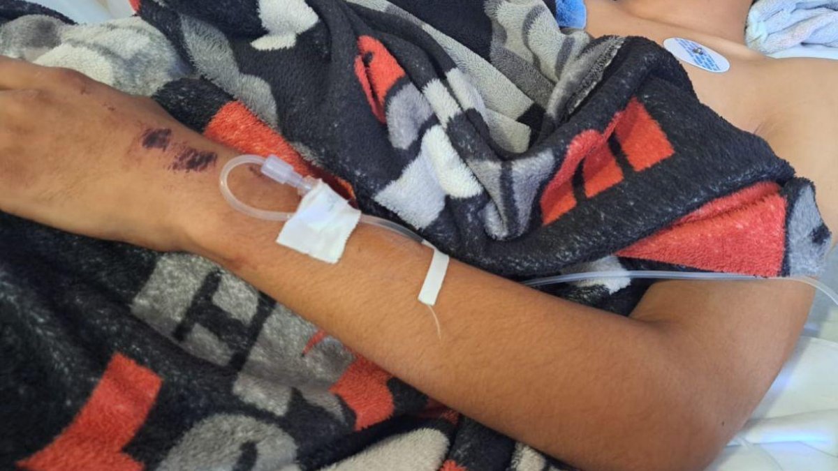 La batalla de Antonio no ha terminado; el joven electrocutado en Mazatlán necesita apoyo para gastos médicos