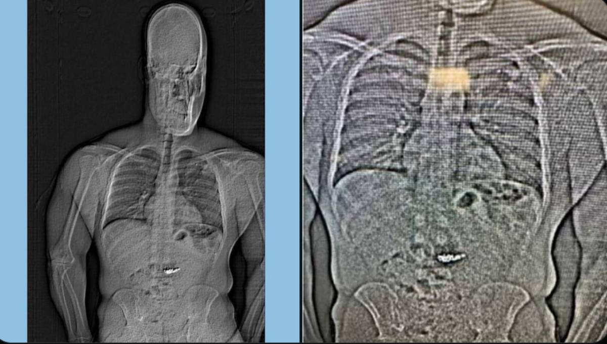 Ladrón se traga aretes de diamantes de 770 mil dólares para evitar arresto en Florida