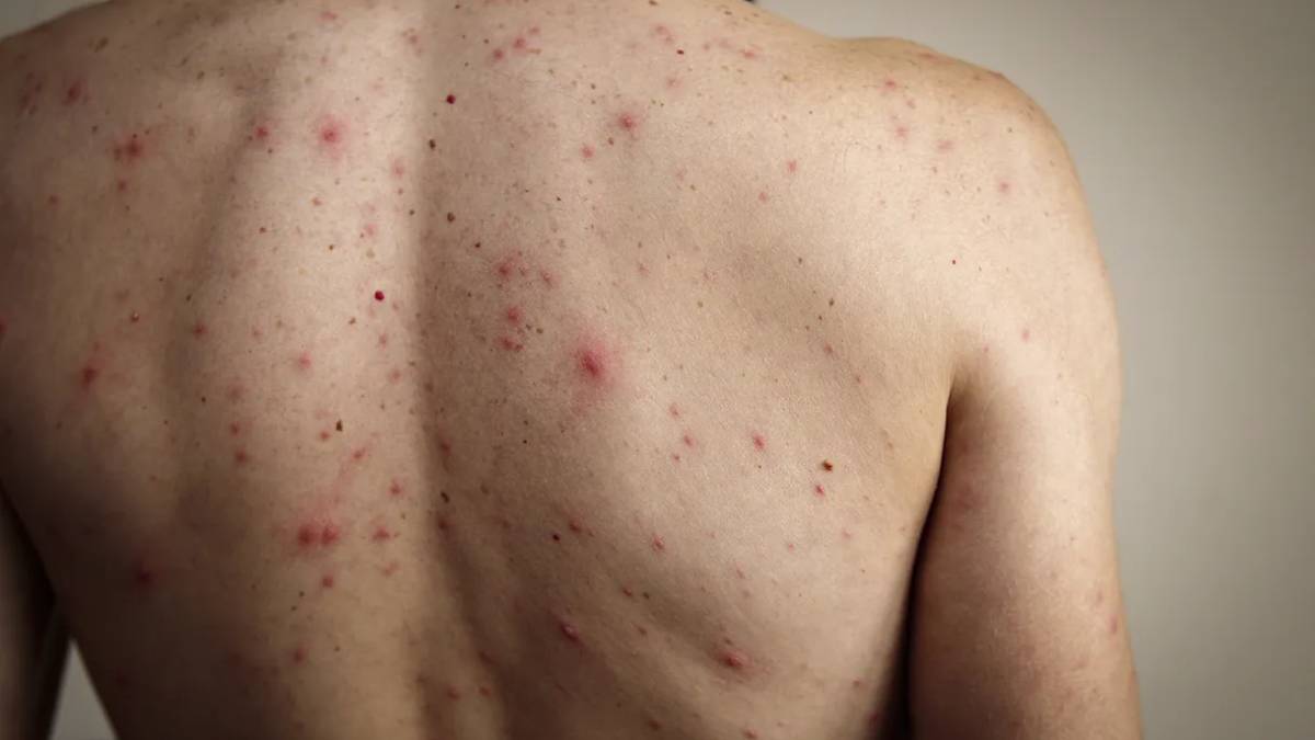 Confirma Jurisdicción Sanitaria: son ya nueve los casos de sarampión en Juan José Ríos