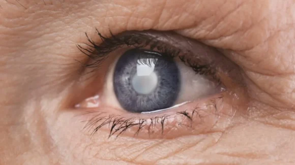¡Solicita una valoración! Secretaría de Salud dispone de cirugías de cataratas gratis para mayores de 60 años
