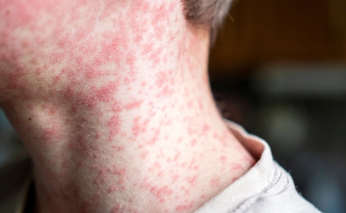 Cuello con marcas de sarampión
