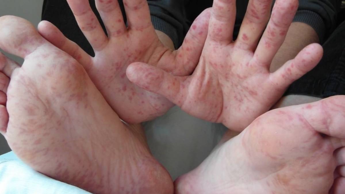 Virus coxsackie