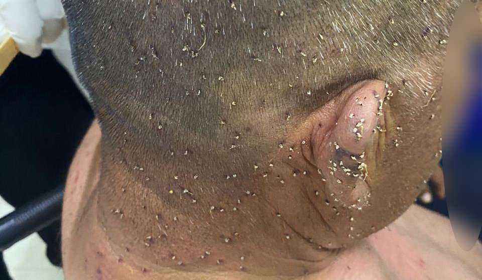 adulto con mil piquetes de abejas en salvador alvarado sin
