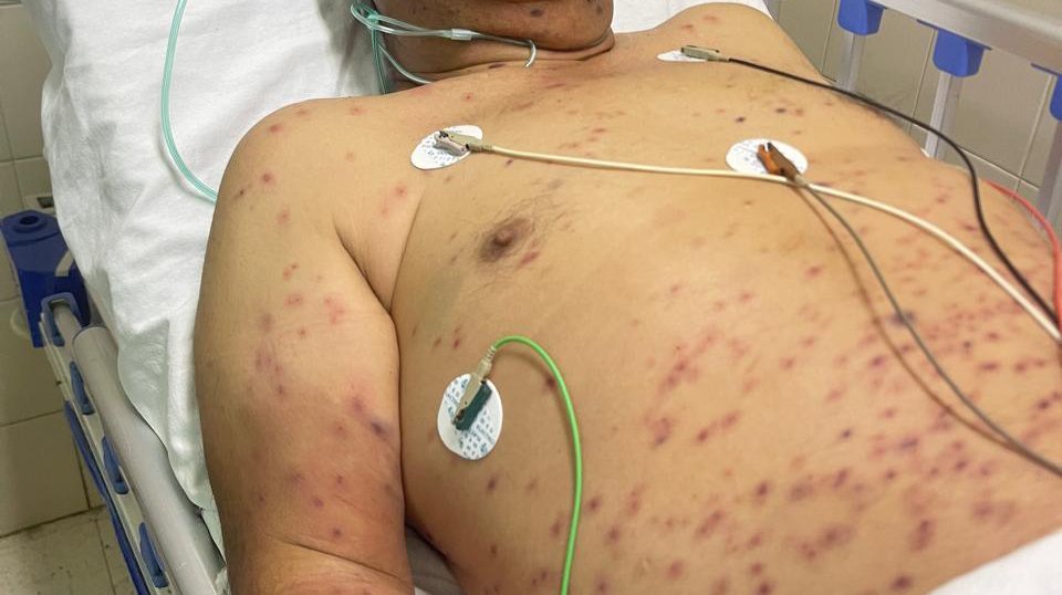 adulto con mil piquetes de abejas en salvador alvarado