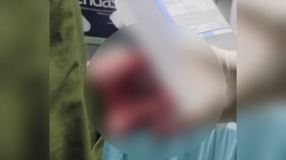 ¡Tres son menores de edad! Confirma SSA 4 lesionados por pirotecnia en la jornada de Nochebuena en todo Sinaloa