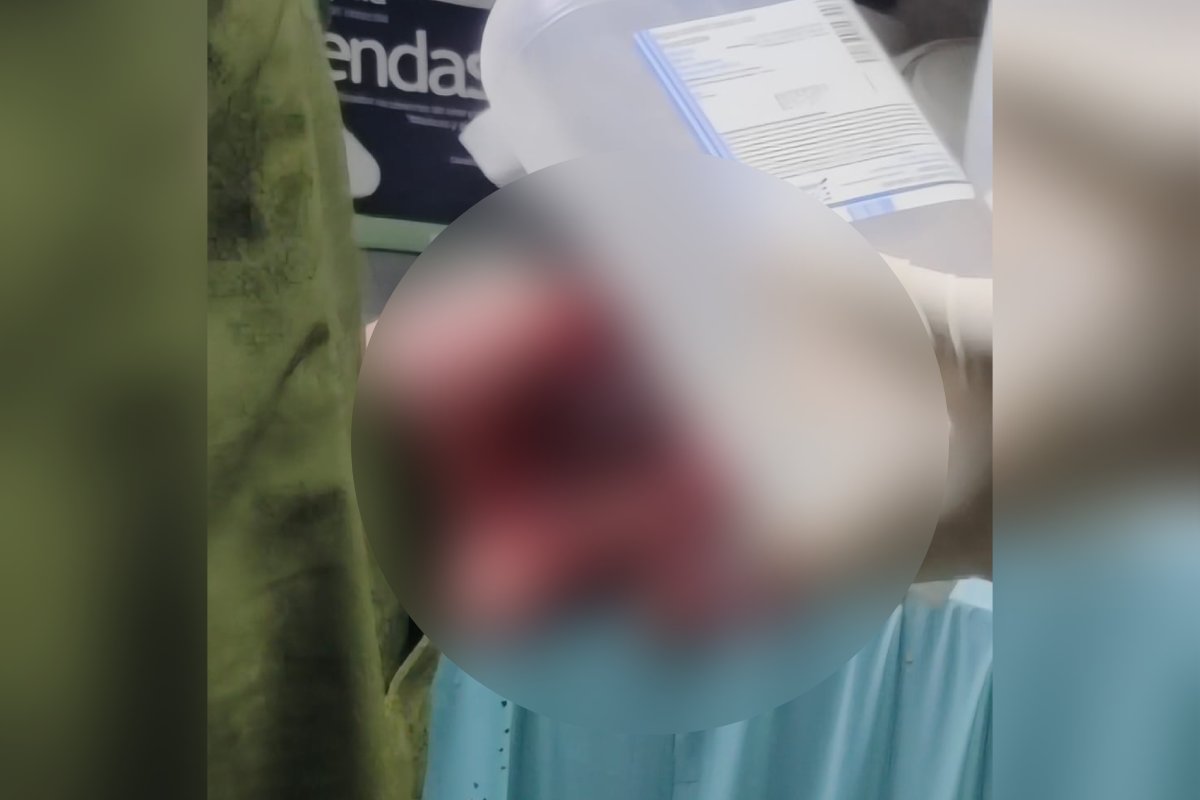 amputación de dedos por explosión de pirotecnia