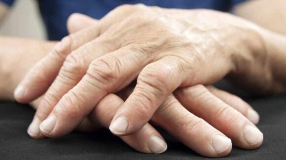 Osteoartritis afecta al 60 % de los mexicanos y se agrava en invierno: especialista