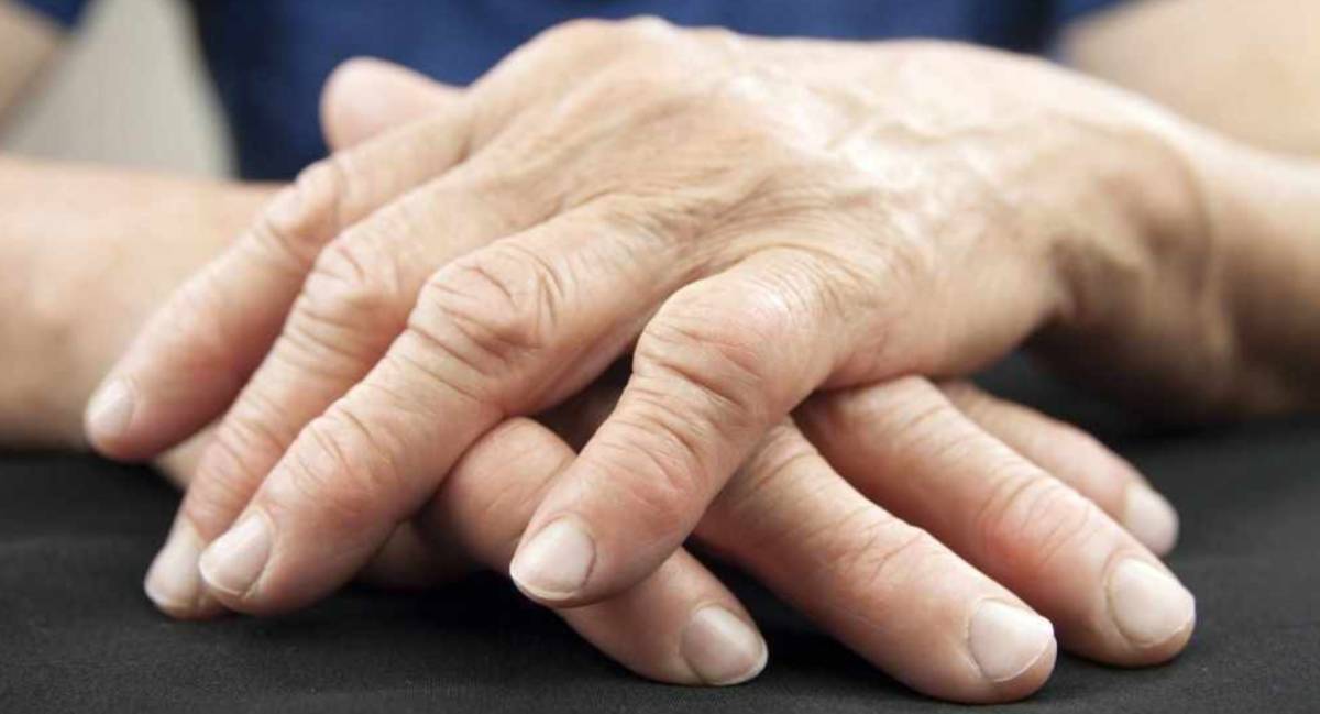 La osteoartritis u osteoartrosis es una enfermedad crónico-degenerativa que afecta a las articulaciones