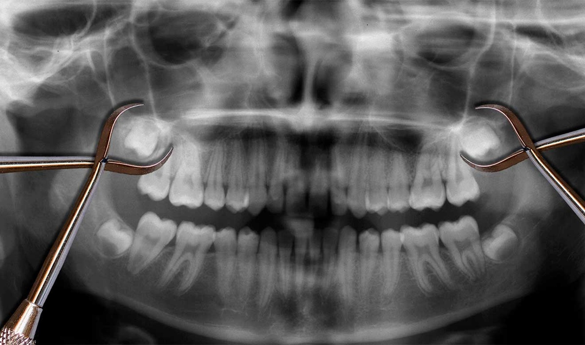 Radiografía de dentadura con muelas del juicio