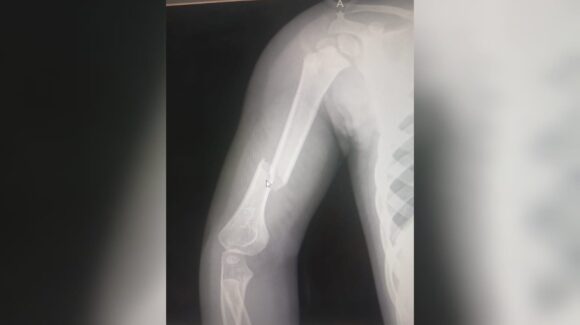 Patronato del Parque Sinaloa sí ha brindado apoyo a familia de Valeria, la niña fracturada con las letras “Los Mochis”, aclara Comunicación Social
