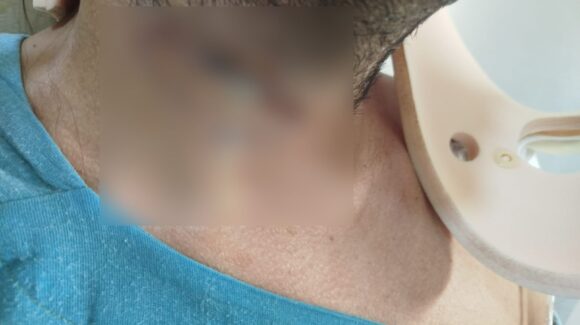 Denuncian presunta negligencia médica en IMSS Mazatlán; paciente sufre infección tras cirugía