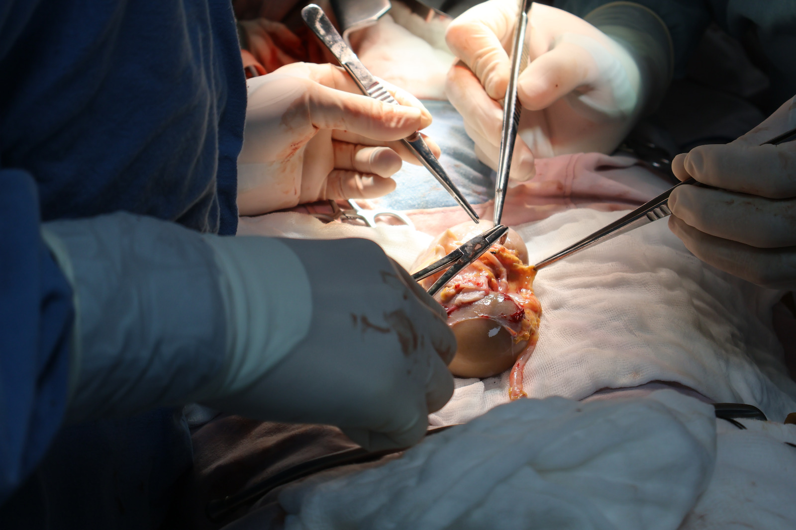 Médicos especialistas realizando trasplante renal