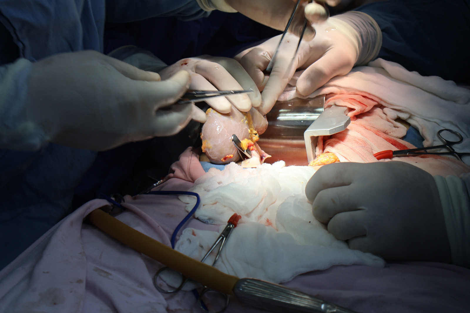 Médicos especialistas realizando trasplante renal