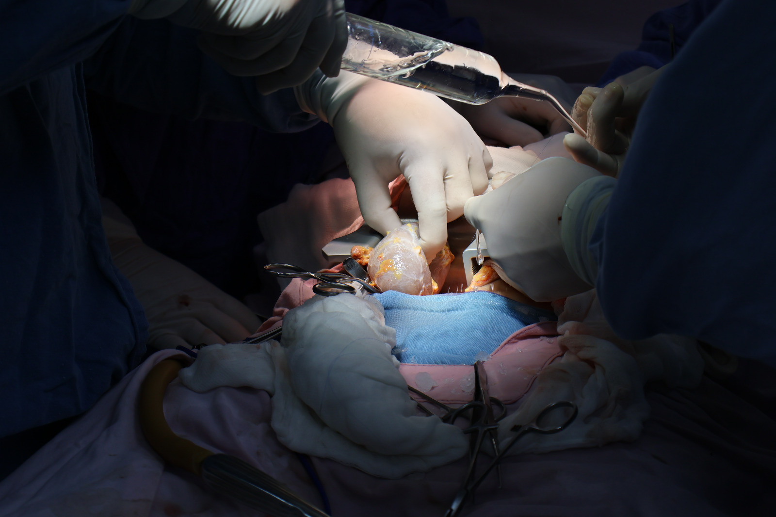 Médicos especialistas realizando trasplante renal