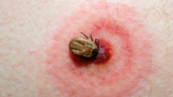 Una pequeña garrapata, puede originar grandes problemas de salud… conoce que es la Enfermedad de Lyme