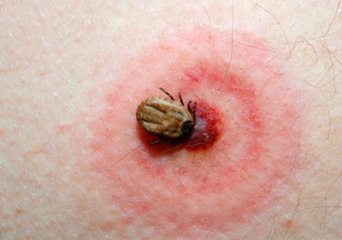 Garrapata en herida de la Enfermedad de Lyme