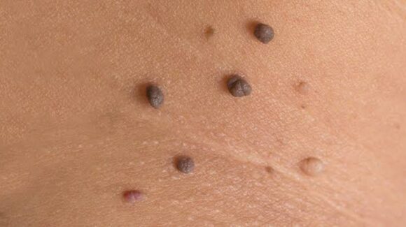 ¡Molestas verrugas! ¿Conoce qué son, como tratarlas y cuándo se necesita ir al médico?