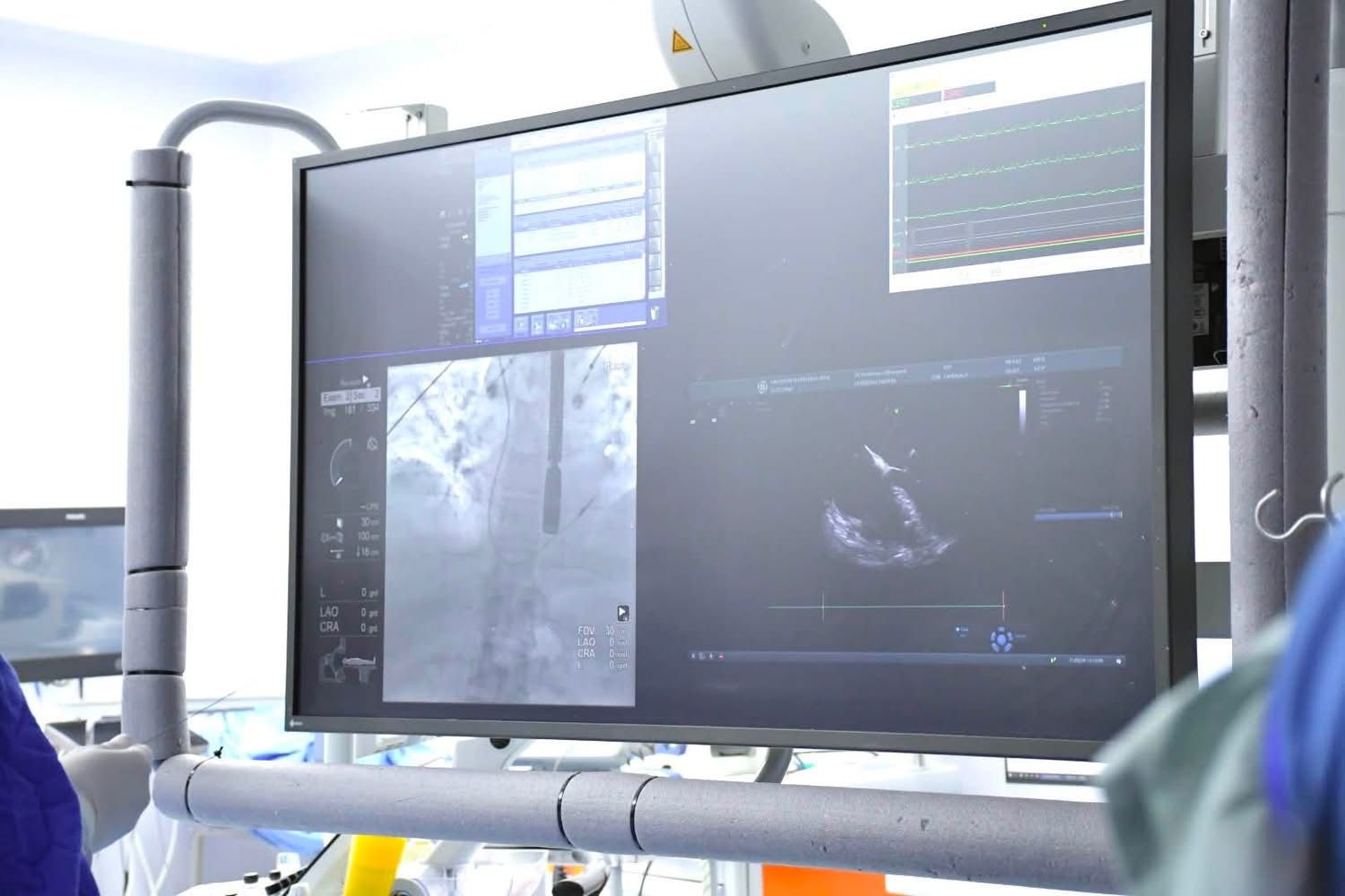 Implantación de marcapasos inalámbrico en el ISSSTE de Culiacán