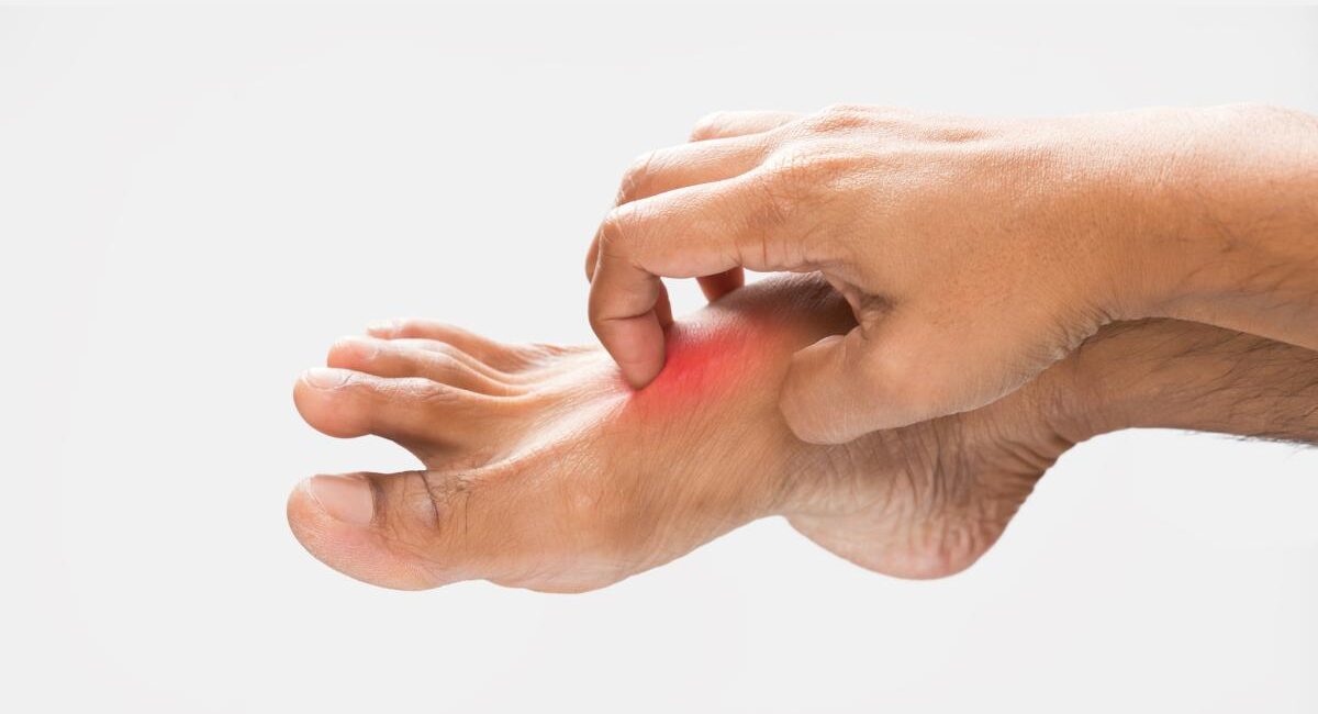 ¿Comezón en pies y manos? Estas son algunas de las causas más frecuentes de la urticaria y cómo aliviarla