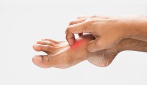 ¿Comezón en pies y manos? Estas son algunas de las causas más frecuentes de la urticaria y cómo aliviarla