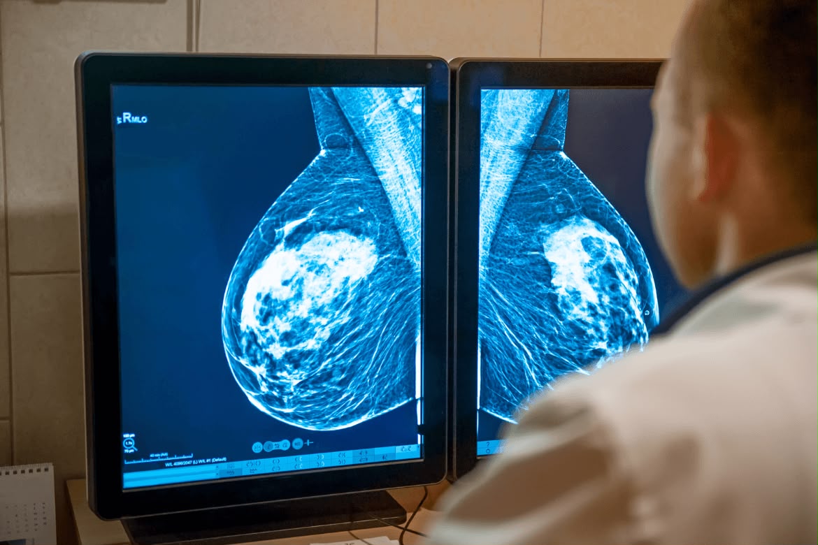 Estudios para detectar a tiempo el cáncer de mama