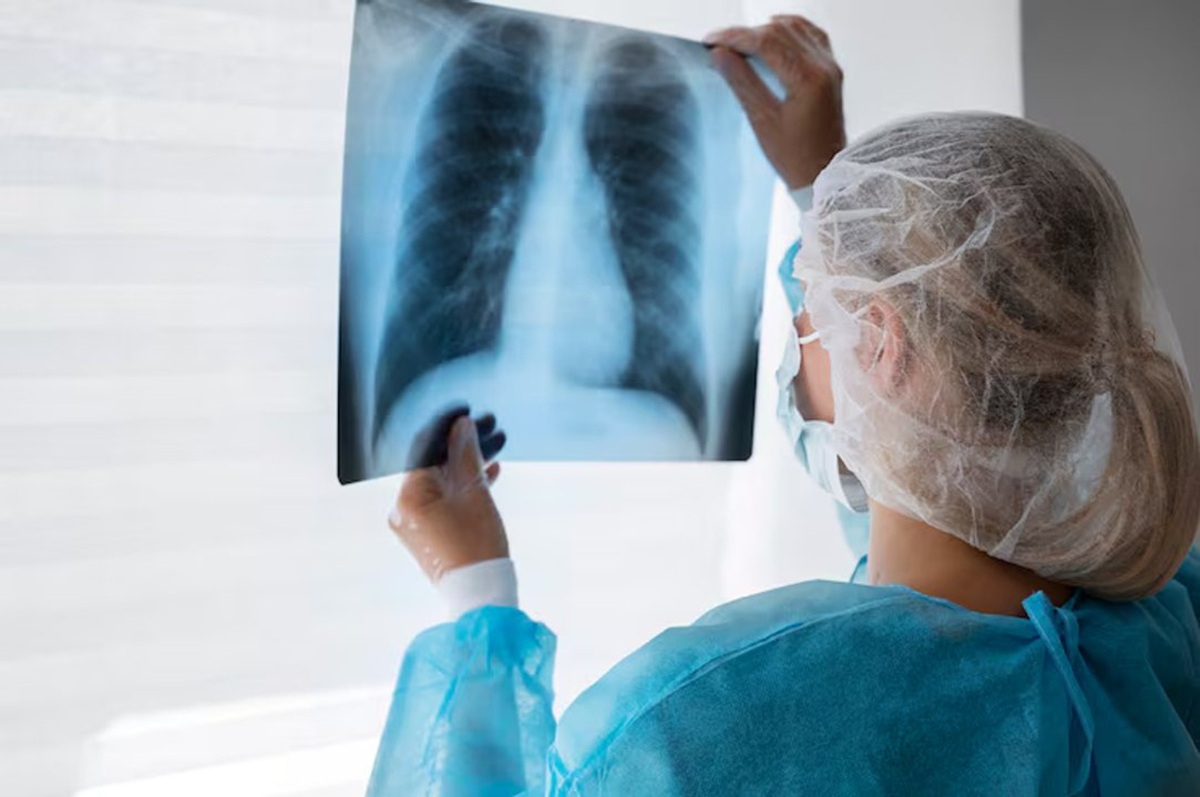 Peste neumónica. Revisión de radiografía de pulmones